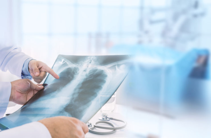 「幫朋友擋掉大劫」乩身堅持仔細檢查肺結節 醫嚇:突然大8倍